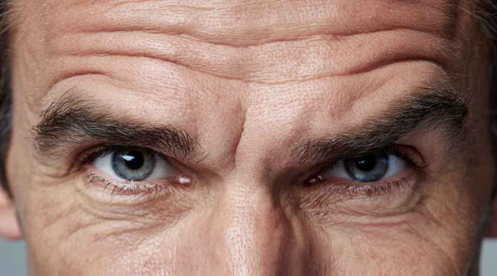 Understanding the Cause of Upper Facial Lines