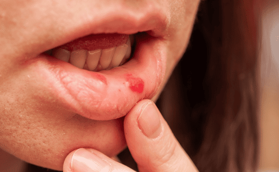 When to Wait Common and Harmless Sores